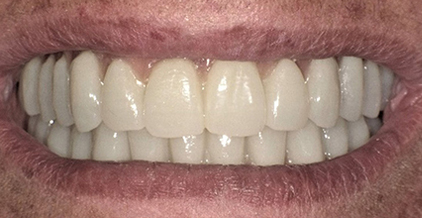 centro implantologia dentale termoli dopo