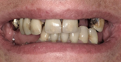 centro implantologia dentale termoli prima